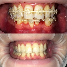 Before and after smile transformation 2