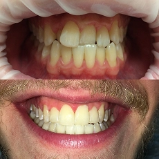 Before and after smile transformation 3