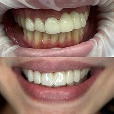 Before and after smile transformation 4