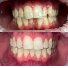Before and after smile transformation 5