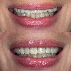 Before and after smile transformation 6