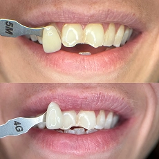 Before and after smile transformation 7