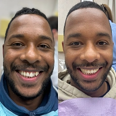 Before and after smile transformation 8