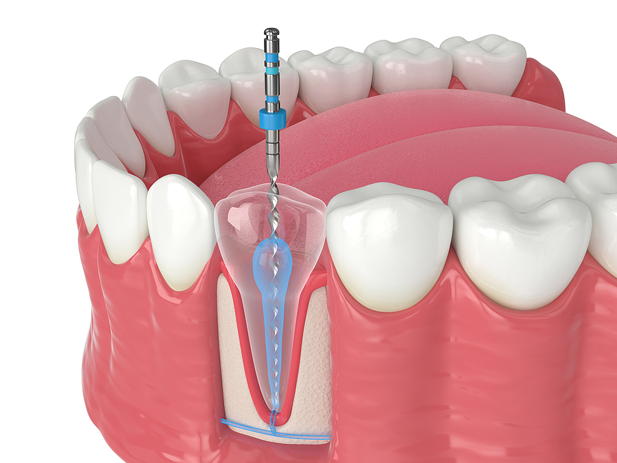 Understanding Endodontics: The Key to Saving Natural Teeth
