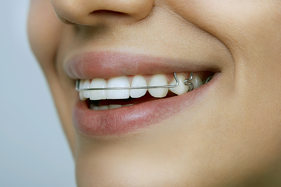 The Importance of Retainers: Maintaining Your Perfect Smile