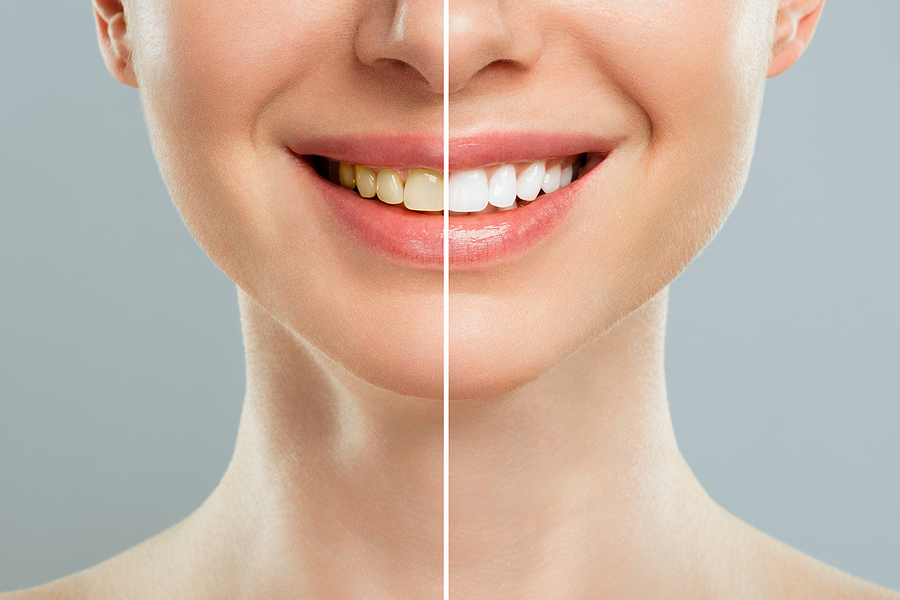 Achieve a Brighter Smile with Professional Teeth Whitening