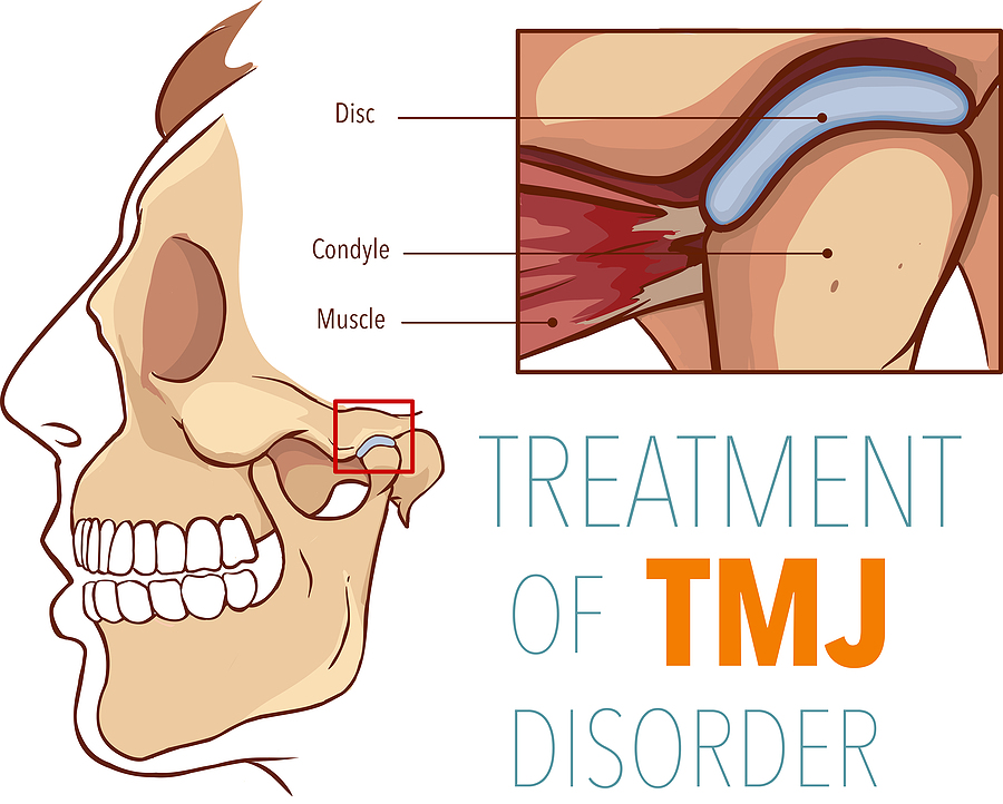 Effective TMJ Treatment: Relieving Jaw Pain and Restoring Comfort